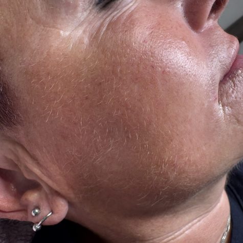 dermaplanning 1